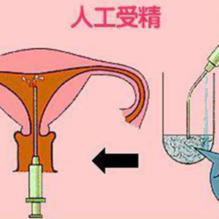 准备做供卵借卵做试管时，怎样才能预防宫腔粘连？