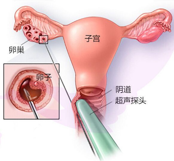 做供卵试管包做成功多少钱