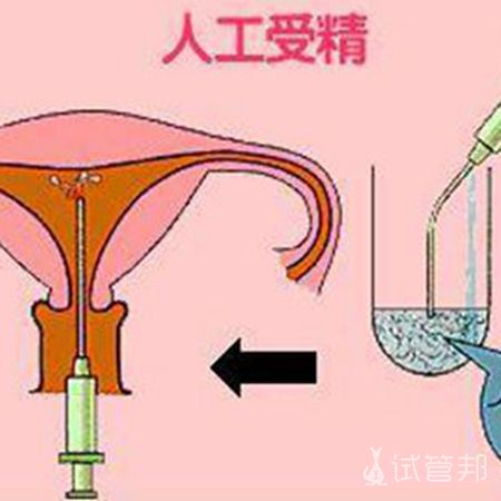 安徽合肥供精试管,花费3万到10万不等…